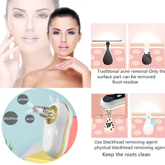 Limpiador eléctrico de puntos negros, máquina portátil personalizable para espinillas, limpieza profunda facial, succión al vacío, limpieza de la piel, máquina de belleza para el cuidado